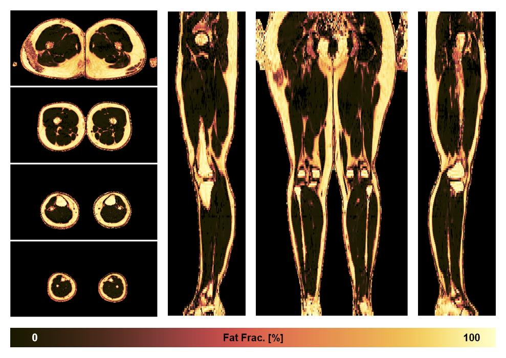 The fat fraction of the lower extremity obtained from the dixon reconstruction for muscle water fat quantification.